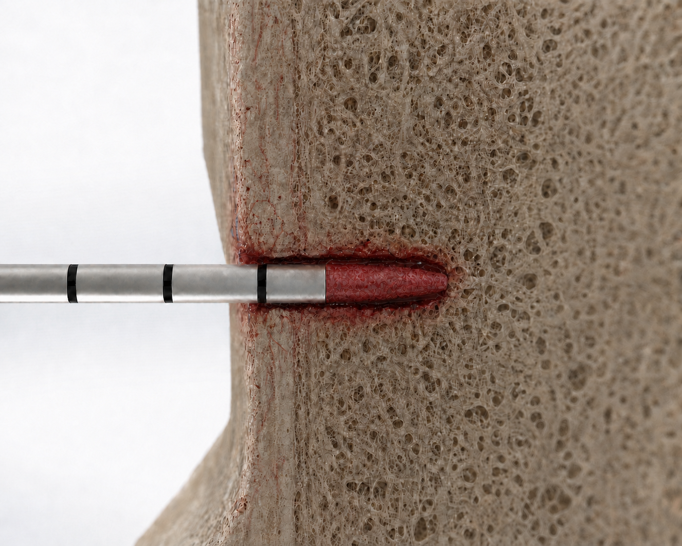 Cross section view of the swaged end of PercuGraft causing the bone to swell inside the cannula